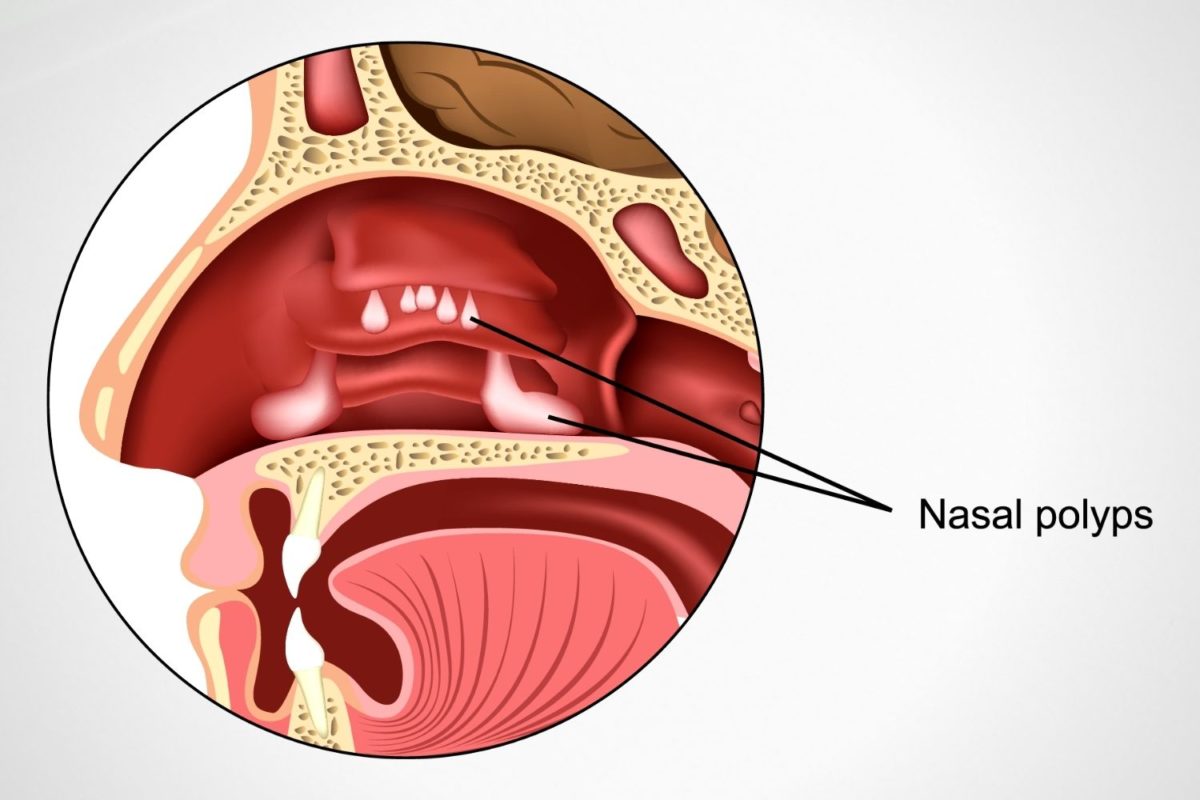 Nasal-Polyps-Otolaryngology-NuLife-Hospital-1-1200x800.jpg