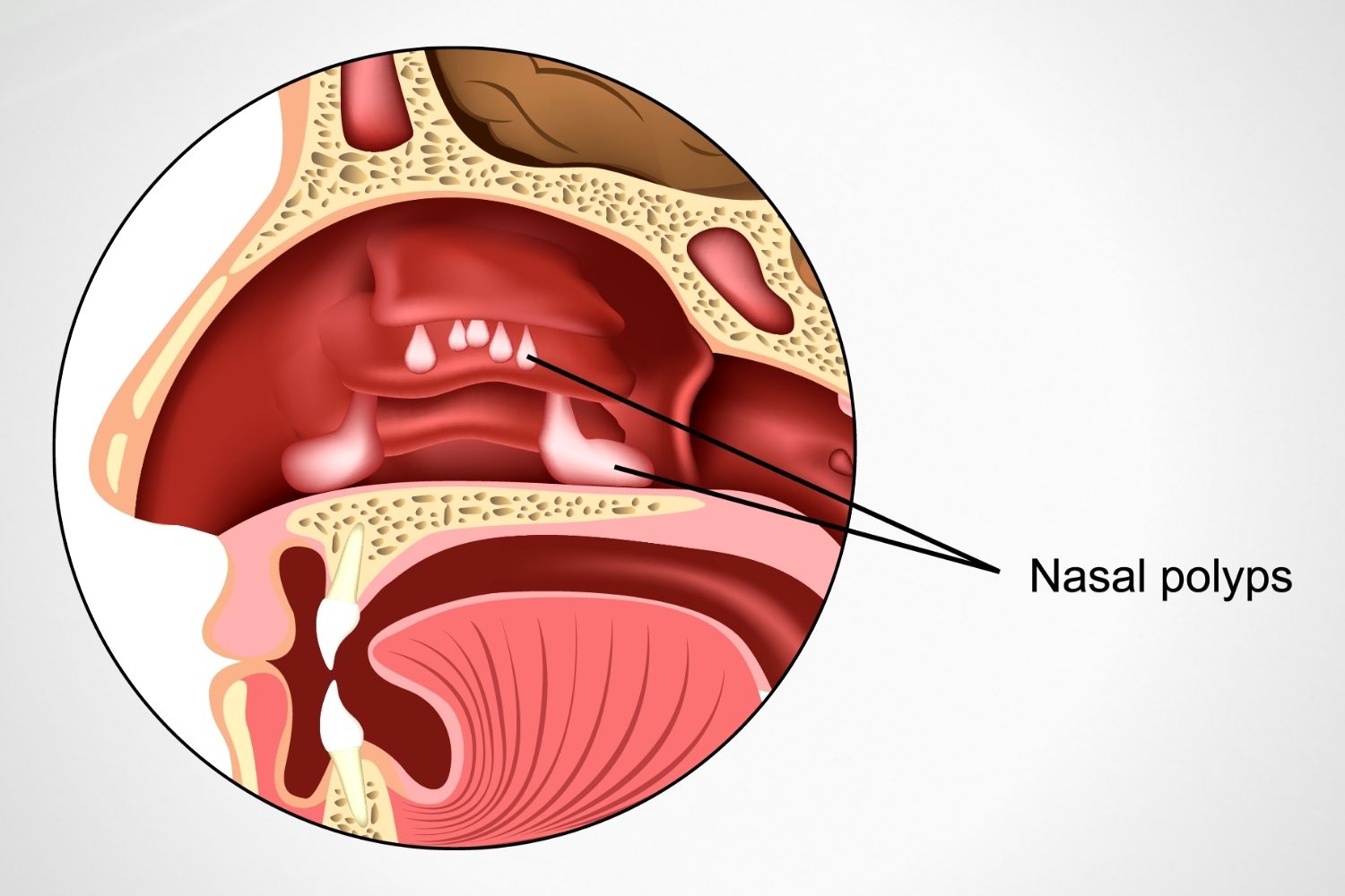 https://www.nulifehospitals.com/wp-content/uploads/2021/04/Nasal-Polyps-Otolaryngology-NuLife-Hospital-1.jpg